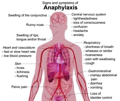 Anaphylaxis