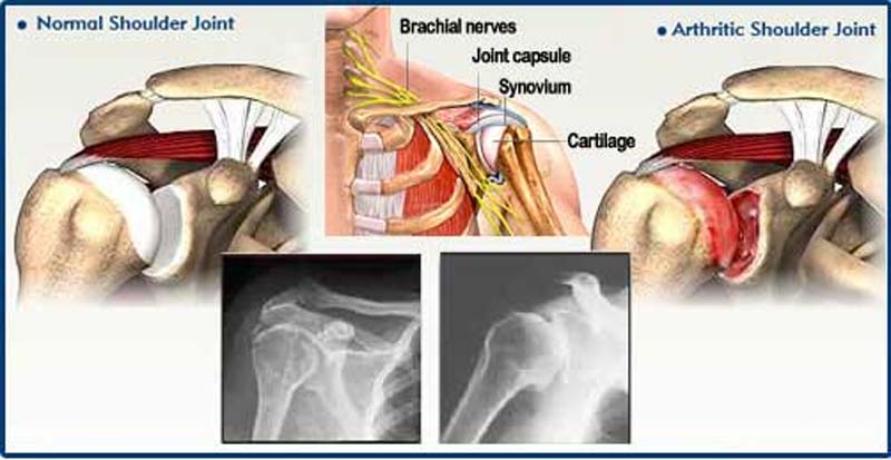 Homeopathy for Arthritis