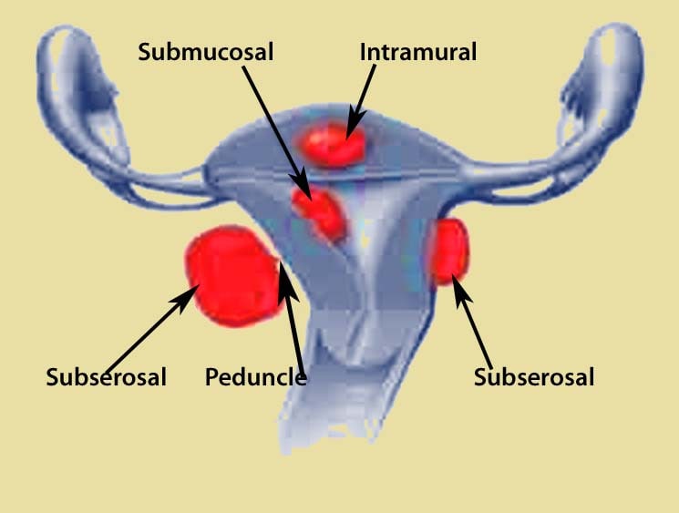 fibroids