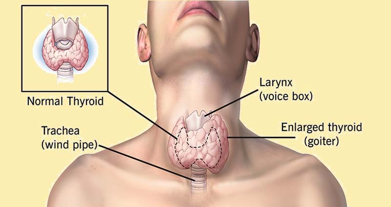 goiter treatment in dubai