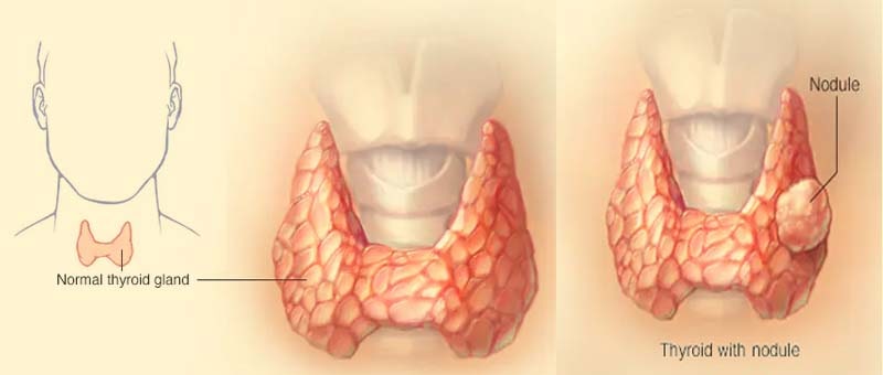 Thyroid cancer