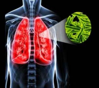 Tuberculosis