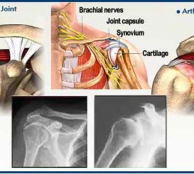 Homeopathy for Arthritis 