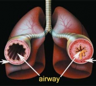 asthma