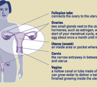 fibroids