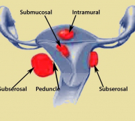 fibroids