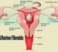 fibroids