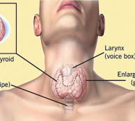 goiter treatment in dubai