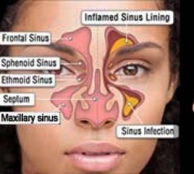 sinusitis