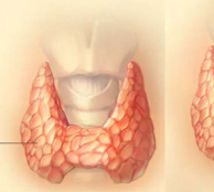 Thyroid cancer