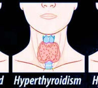 Thyroid