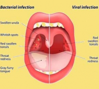 Tonsillitis homeopathy