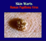 warts